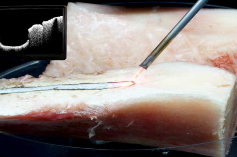 Spinal canal stenosis surgery conducted with laser and visual control via OCT (Image: LZH)