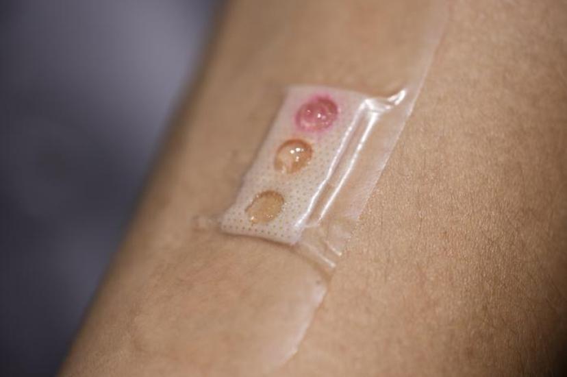 NTU’s ‘smart-plaster’ includes microlaser sensors embedded in liquid crystal droplets, and is customised to read three types of biomarkers, lactate, glucose and urea