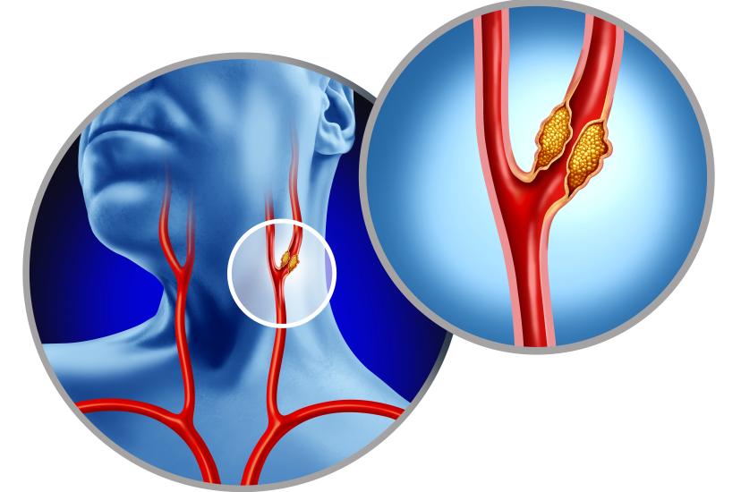 Carotid artery plaque analysis