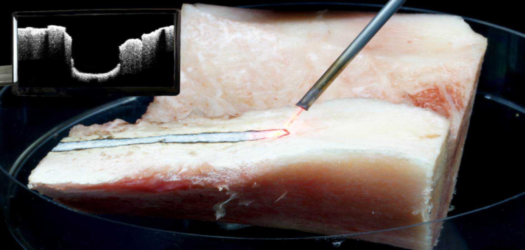 Spinal canal stenosis surgery conducted with laser and visual control via OCT (Image: LZH) Spinal canal stenosis surgery conducted with laser and visual control via OCT (Image: LZH)