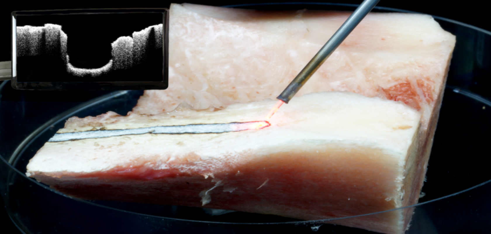 Spinal canal stenosis surgery conducted with laser and visual control via OCT (Image: LZH)