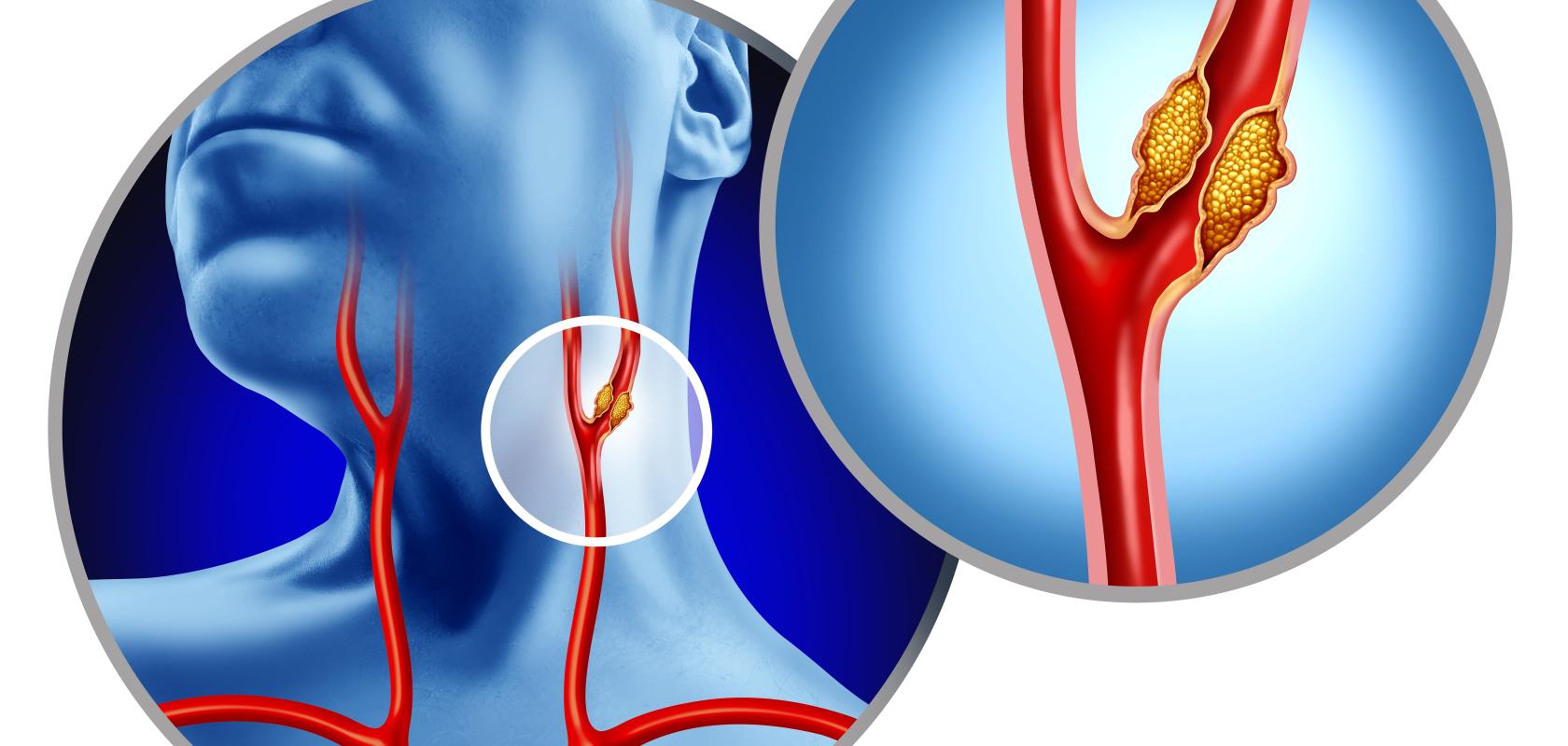 Carotid artery plaque analysis