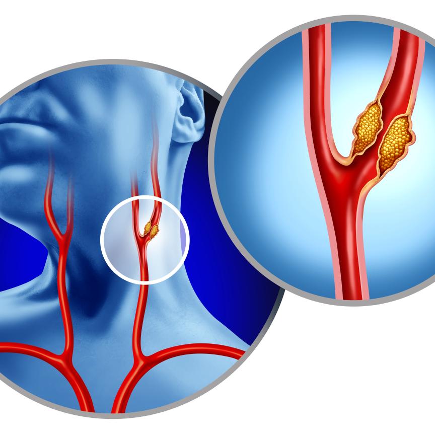 Carotid artery plaque analysis